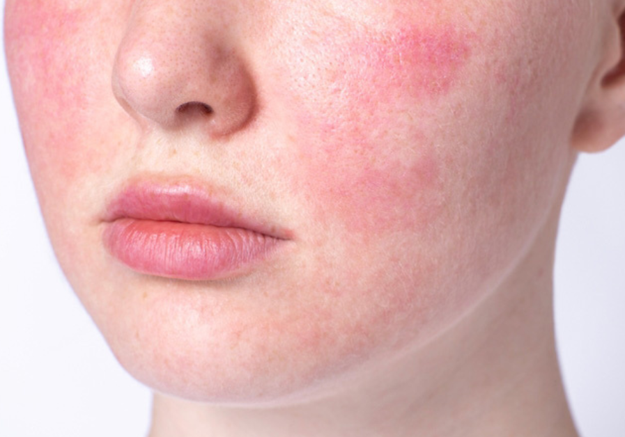 How to Soothe Rosacea with a Gentle Korean Skincare Routine