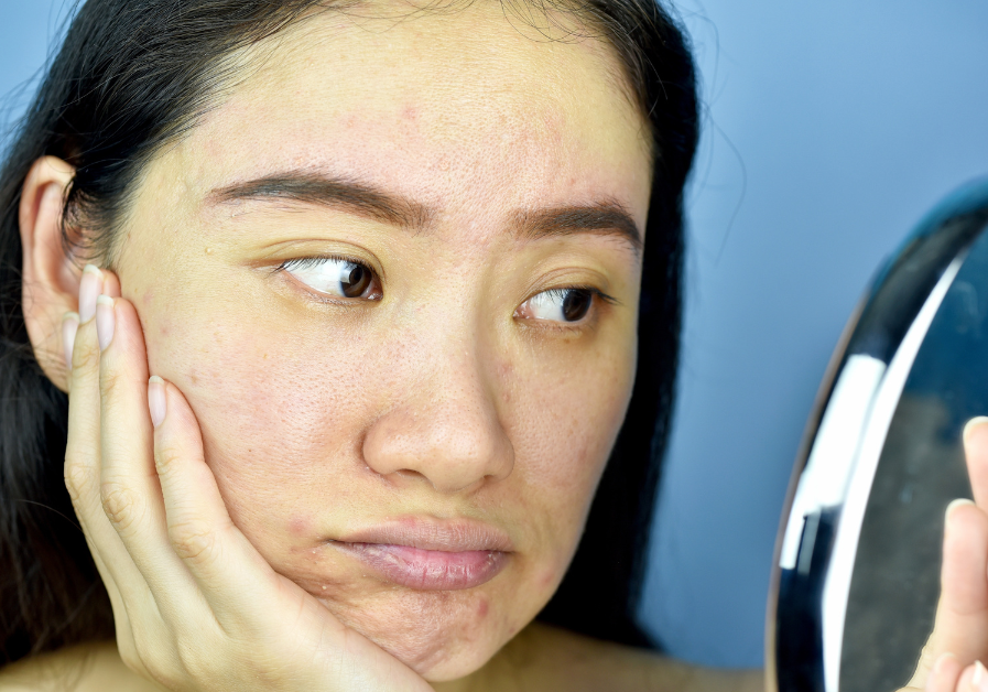 Best Non-Comedogenic Korean Skincare Brands for Acne-Prone Skin